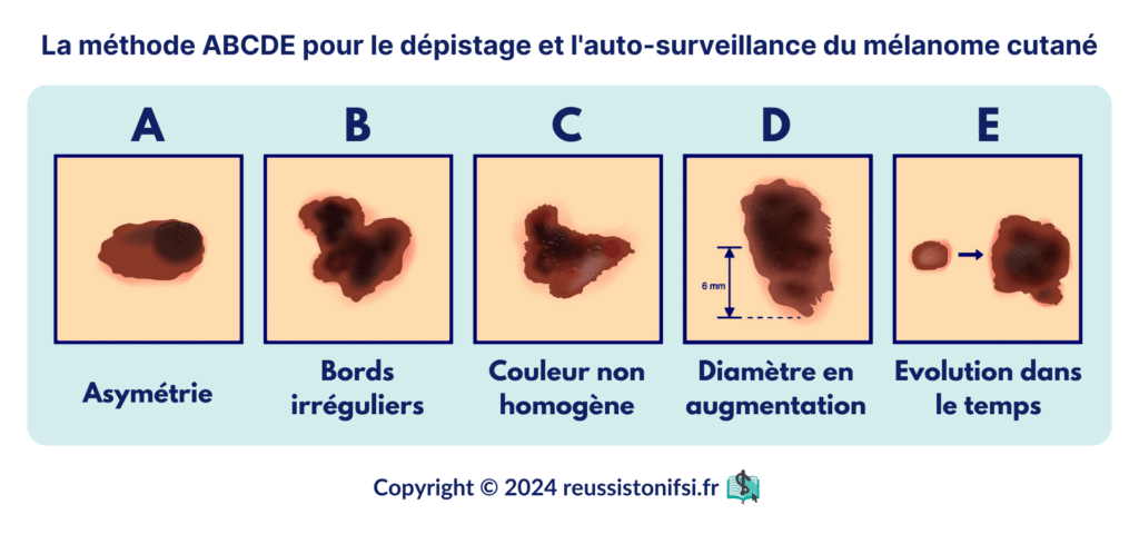 Infographie - La méthode ABCDE pour le dépistage et l'auto-surveillance du mélanome cutané