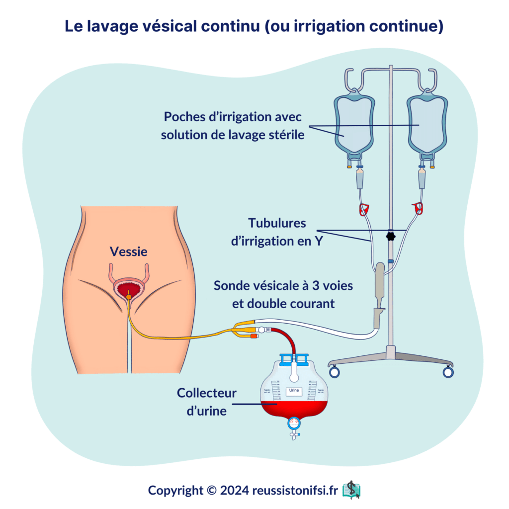 Infographie - Le lavage vésical continu (ou irrigation continue)