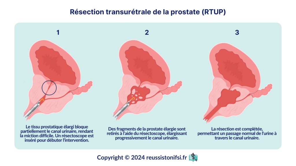 Infographie - Résection transurétrale de la prostate (RTUP)