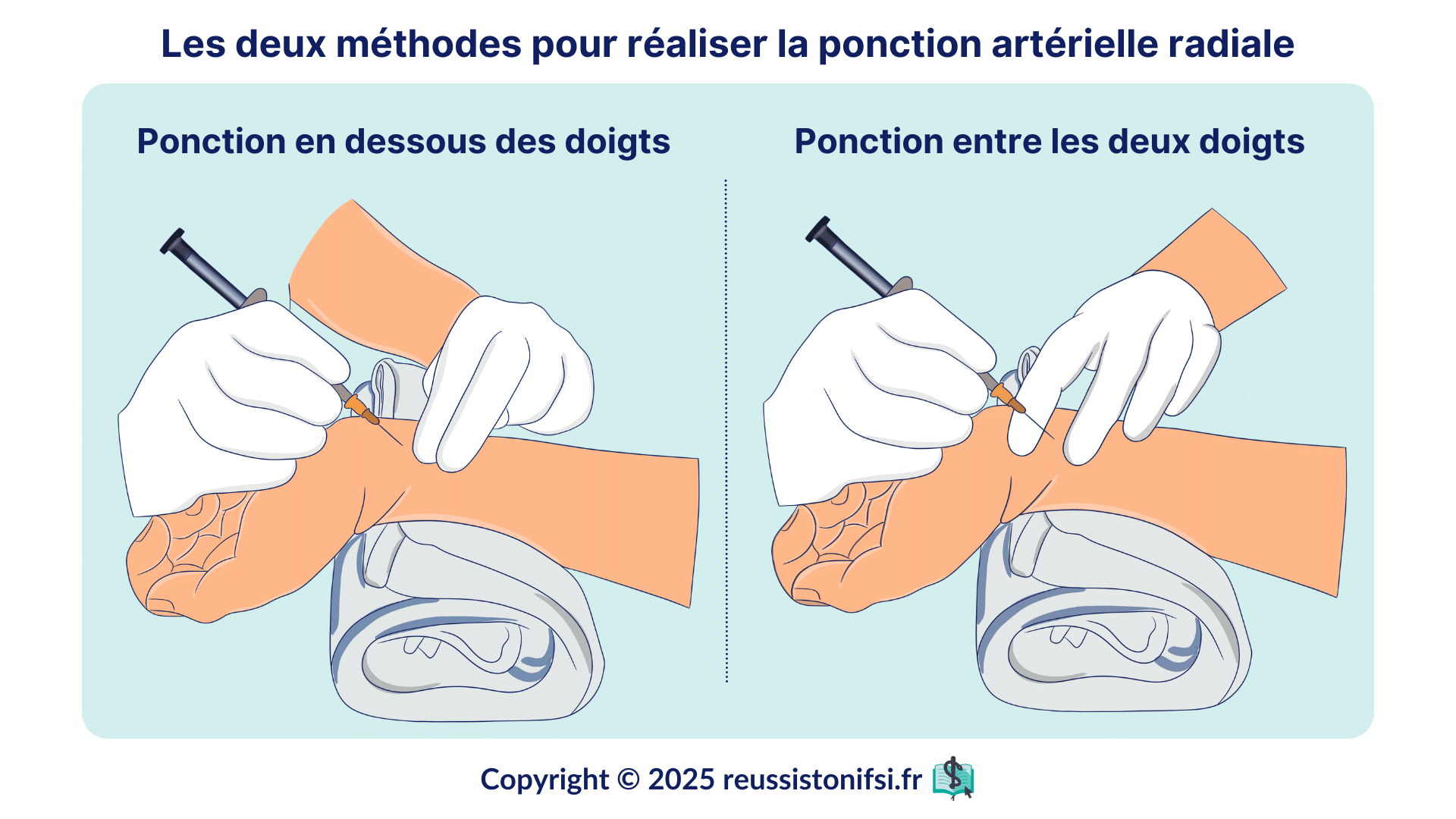 Infographie - Les deux méthodes de positionnement pour réaliser la ponction artérielle radiale pour gaz du sang