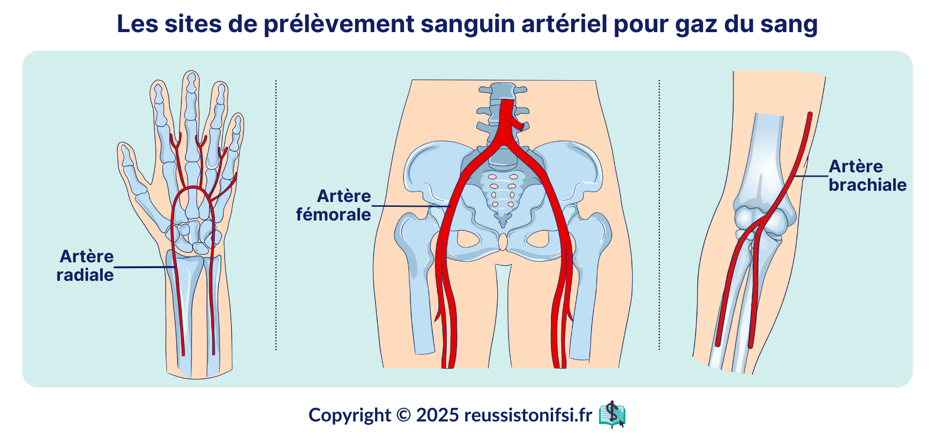 Infographie - sites de prelevement sanguin arteriel pour gaz du sang radial fémoral brachial