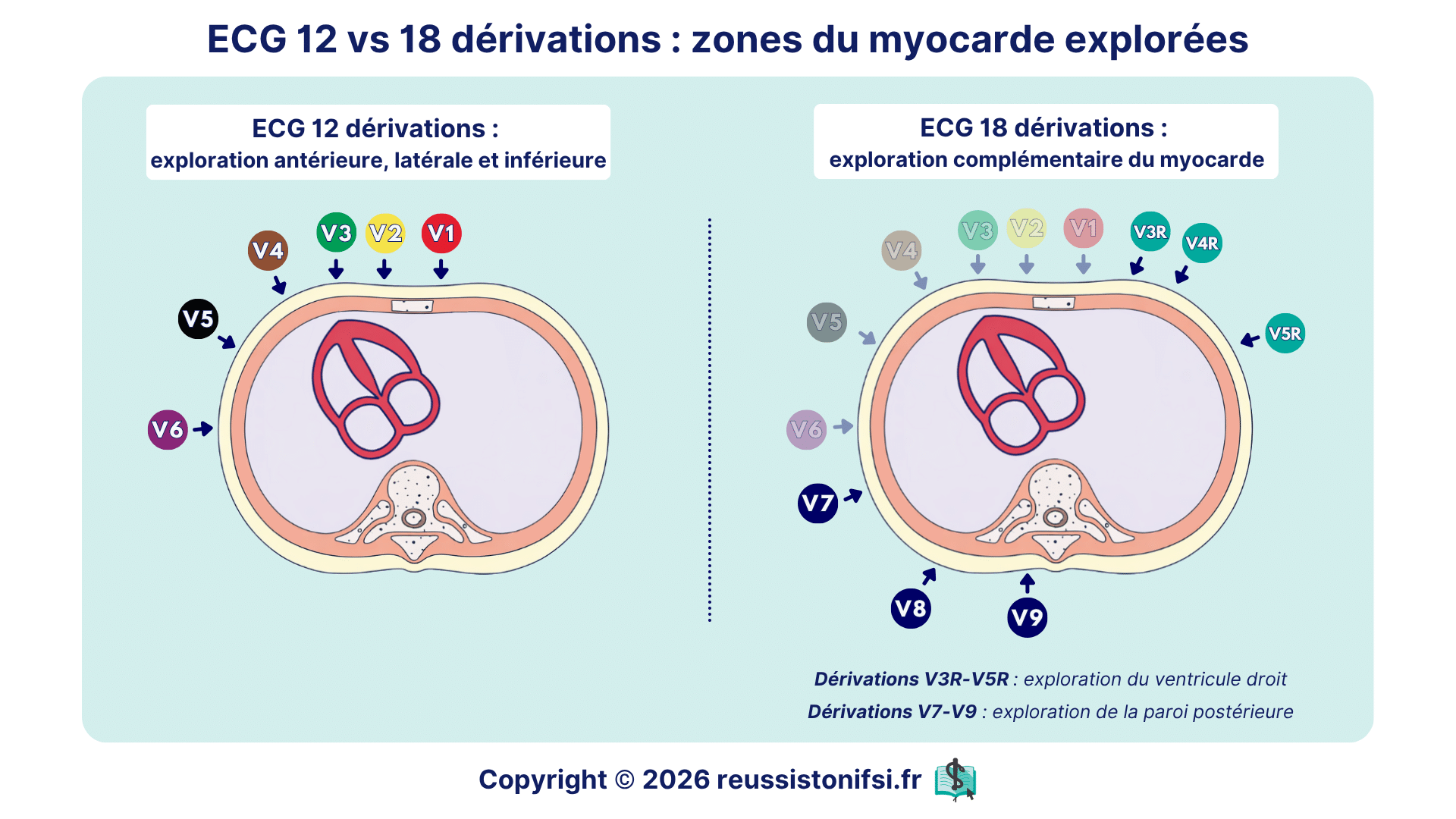 Schéma comparatif ECG 12 et 18 dérivations montrant exploration des parois cardiaques et du ventricule droit