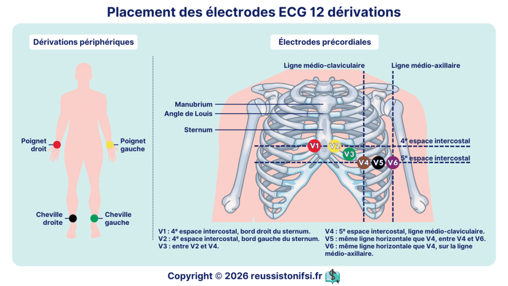 Ecg Comment Examples Électrocardiogramme (ECG) : guide de réalisation pour l’infirmier(e ...