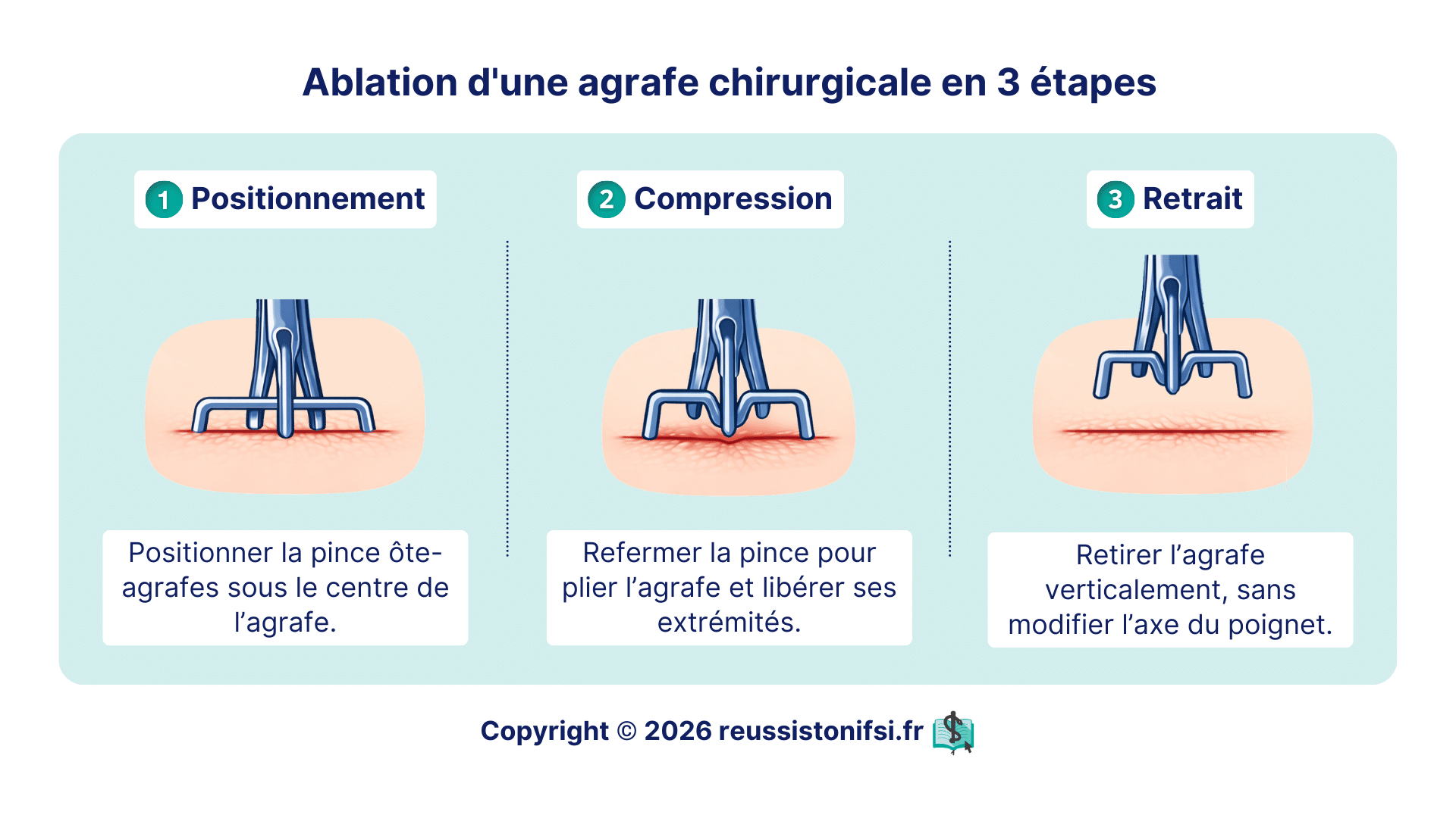 Retrait d’une agrafe chirurgicale avec pince ôte-agrafes en trois temps : positionnement, compression puis extraction verticale