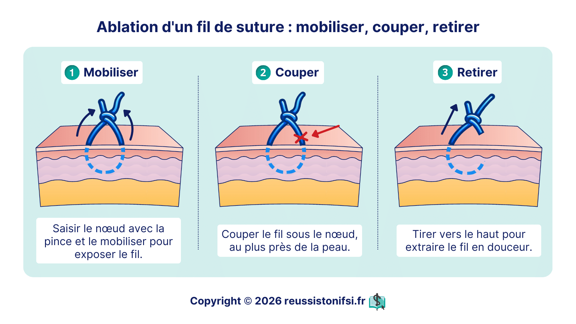 Ablation de fil de suture montrant mobilisation du nœud, section sous-cutanée et retrait atraumatique du fil chez le patient
