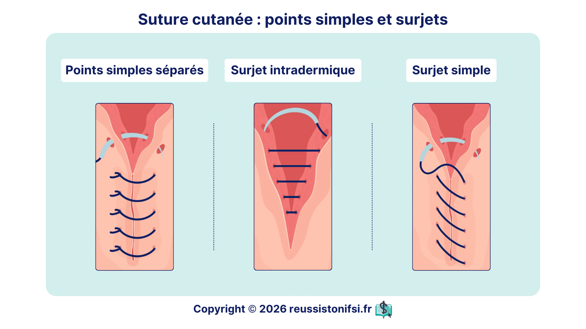 Suture cutanée illustrant points simples séparés, surjet intradermique et surjet simple sur plaie du patient