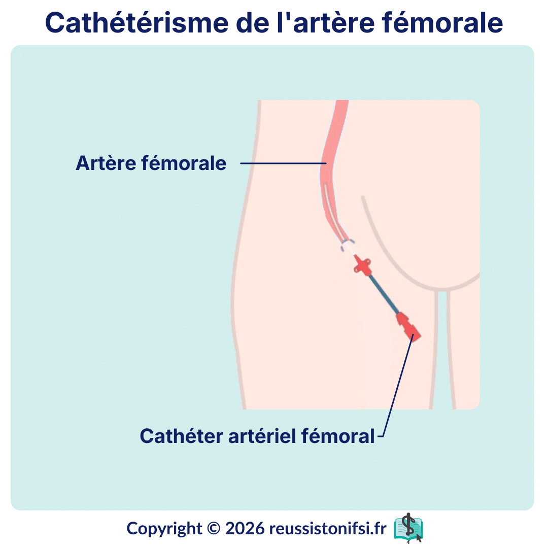Schéma de cathétérisme de l’artère fémorale avec insertion d’un cathéter artériel au pli inguinal