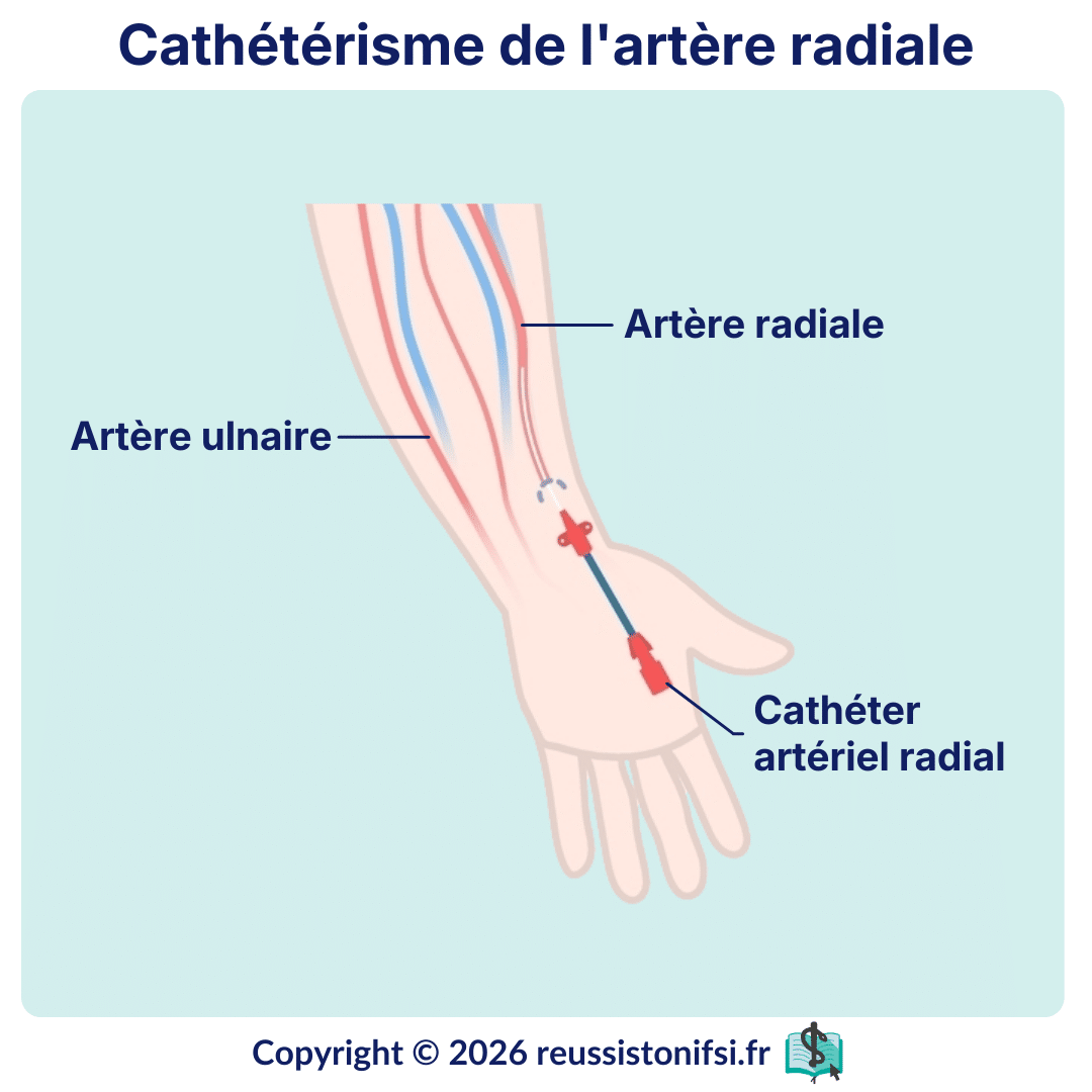 Schéma de cathétérisme de l’artère radiale avec repérage des artères radiale et ulnaire et insertion du cathéter artériel