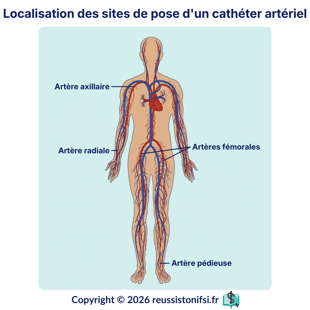 Schéma anatomique des sites de pose d’un cathéter artériel avec artères radiale, fémorale, axillaire et pédieuse