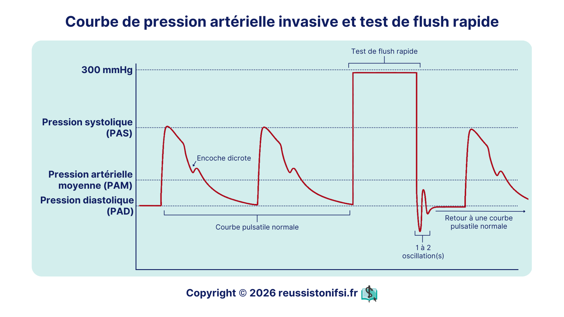 Courbe de pression artérielle invasive avec pression systolique, diastolique, encoche dicrote et test de flush rapide