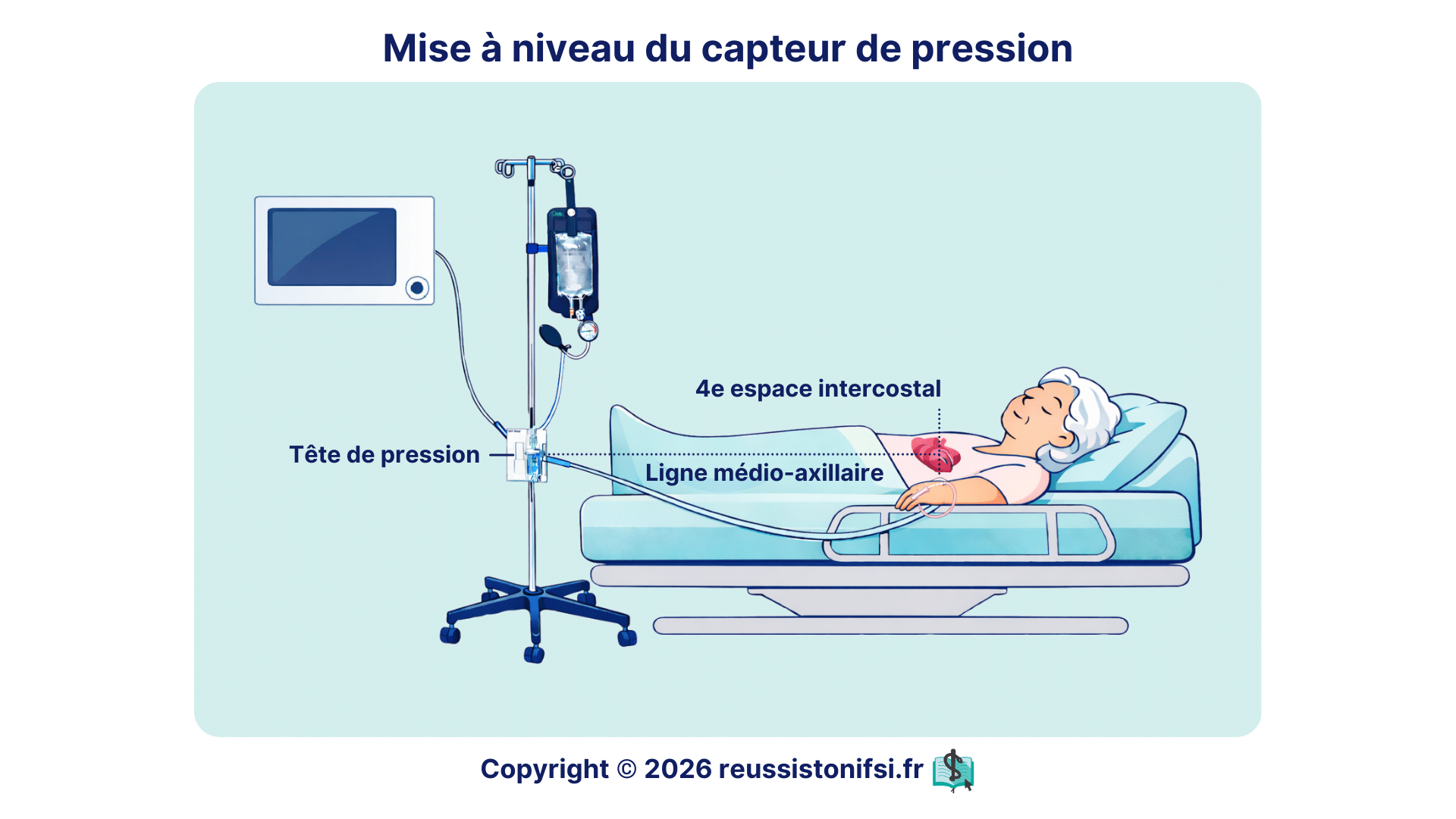 Positionnement du capteur de pression artérielle au niveau de la ligne médio-axillaire, 4e espace intercostal, chez un patient alité