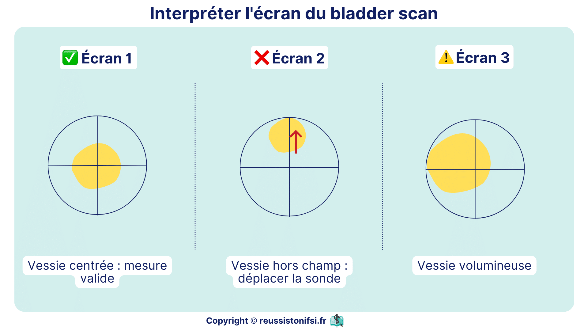Écrans de bladder scan montrant vessie centrée, hors champ nécessitant ajustement de la sonde et vessie volumineuse