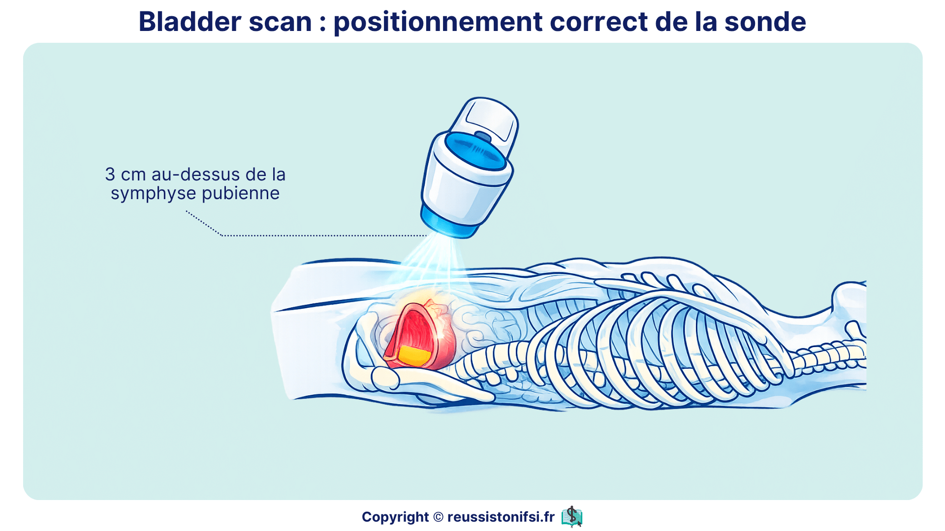 Positionnement de la sonde de bladder scan 3 cm au-dessus de la symphyse pubienne pour mesurer le volume vésical
