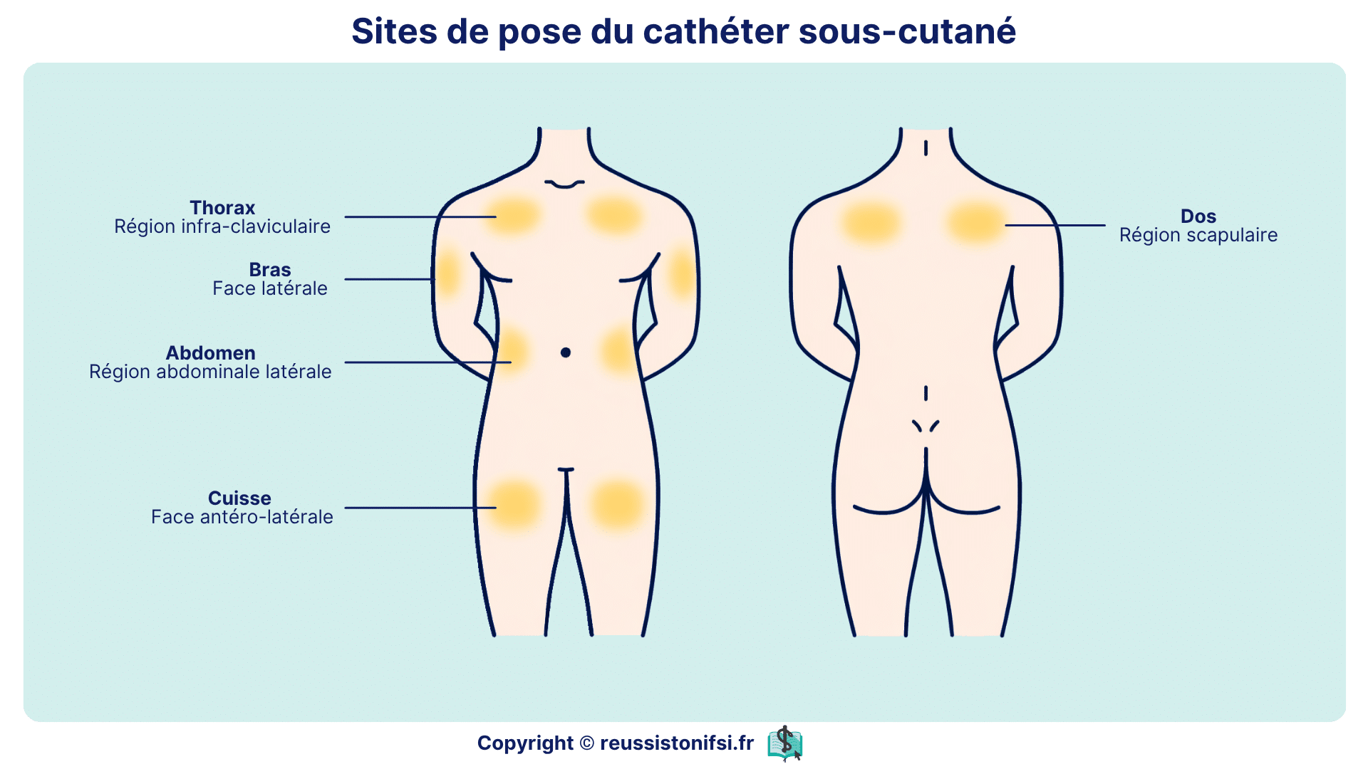 Schéma des zones de pose d’un cathéter sous-cutané : thorax, abdomen, bras, cuisse et région scapulaire