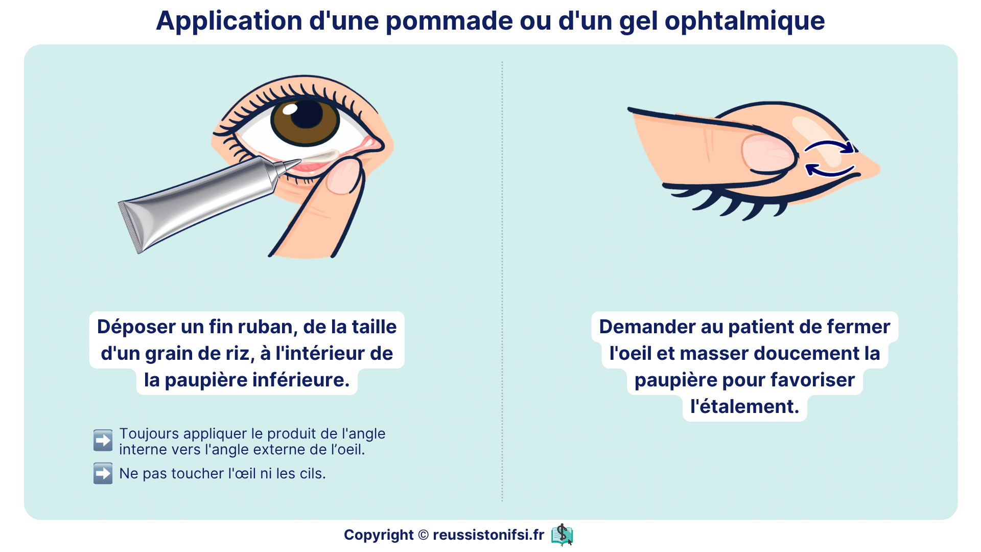 Application d’une pommade ophtalmique dans la paupière inférieure avec massage doux pour diffusion