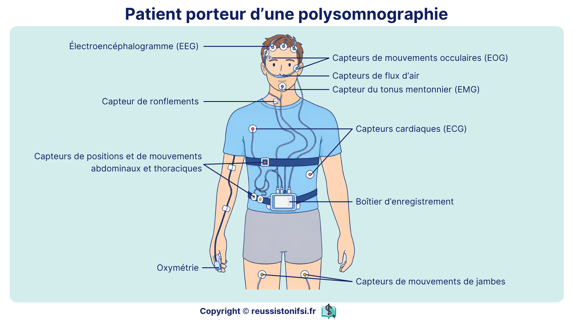 Patient porteur d’une polysomnographie avec capteurs EEG, EOG, ECG, oxymétrie et boîtier d’enregistrement.