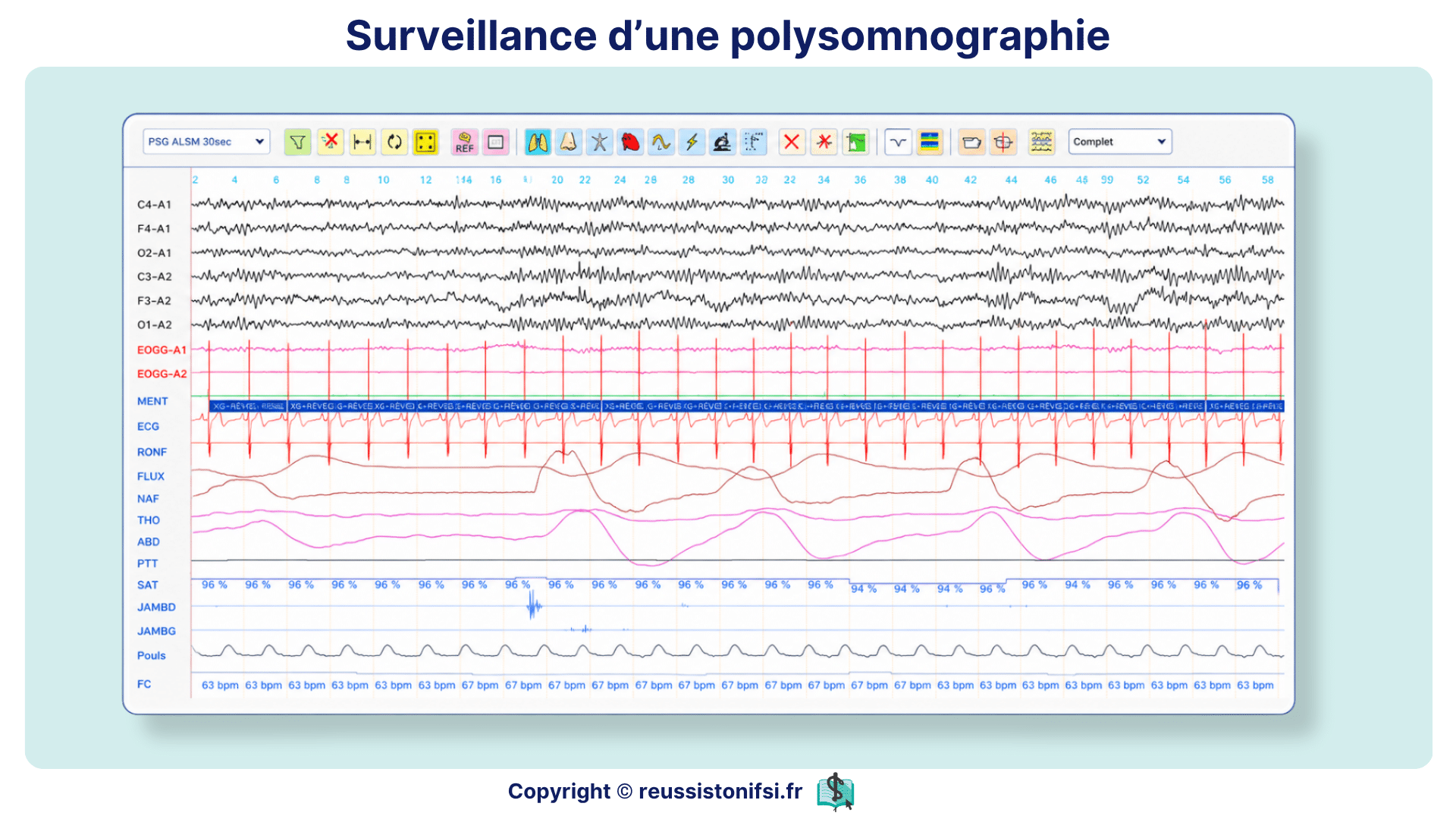 Surveillance d’une polysomnographie avec tracés EEG, ECG, flux respiratoire et saturation en oxygène.