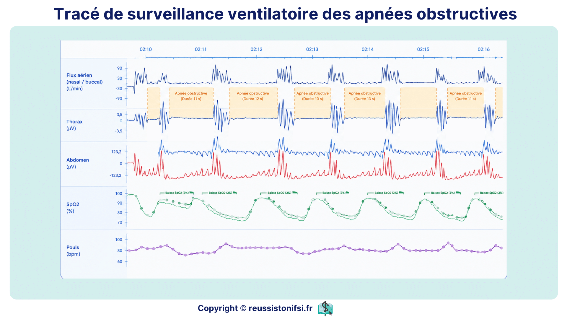 Tracé de surveillance ventilatoire montrant des apnées obstructives avec flux aérien, SpO2 et mouvements thoraciques.