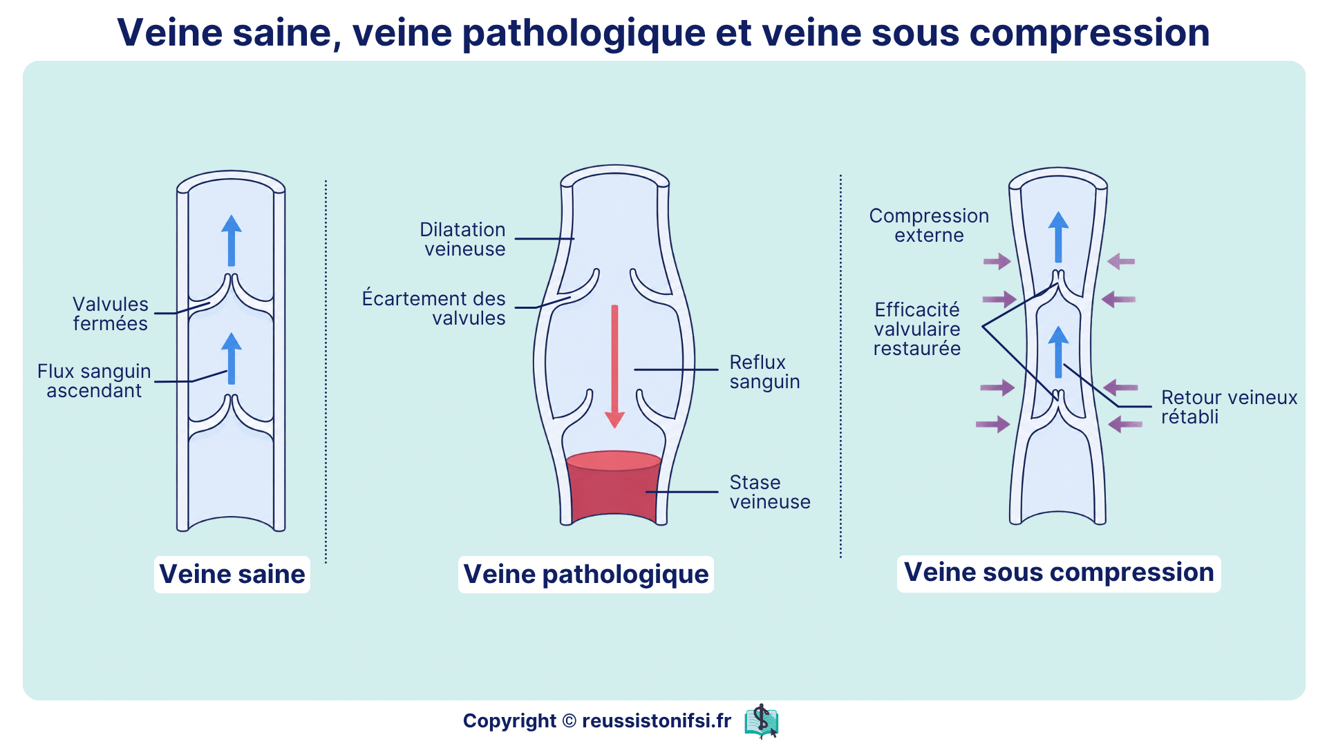 Comparaison entre veine saine, veine pathologique et veine sous compression avec reflux et retour veineux.