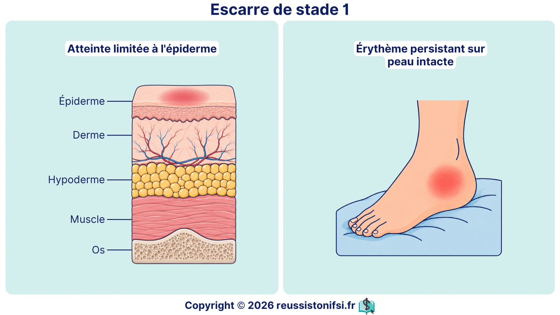 Escarre de stade 1 avec érythème persistant sur peau intacte et coupe des couches cutanées.