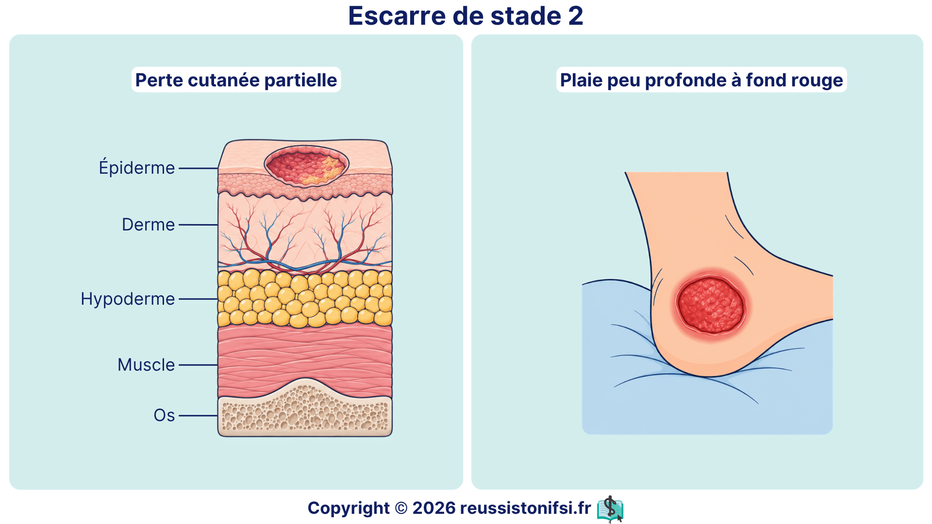 Escarre de stade 2 avec perte cutanée partielle et plaie peu profonde à fond rouge.