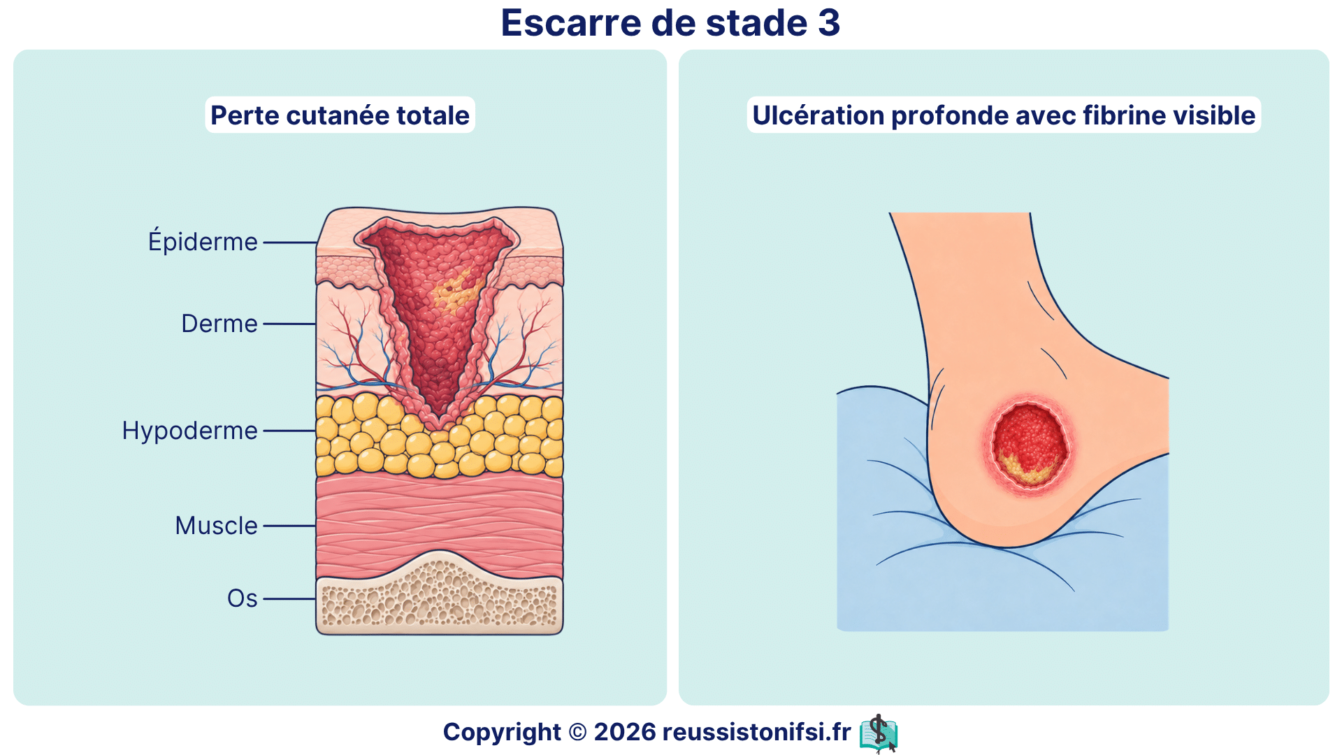 Escarre de stade 3 avec perte cutanée totale, ulcération profonde et fibrine visible.