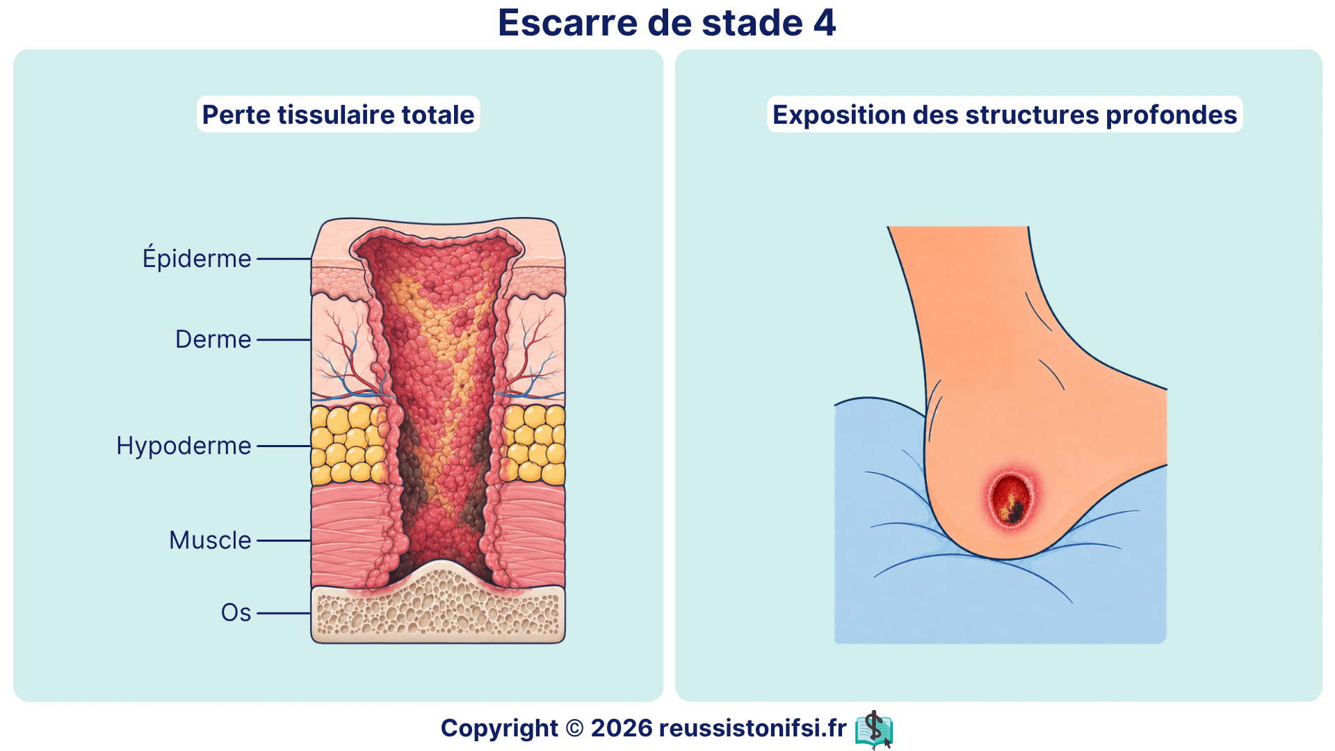 Escarre de stade 4 avec perte tissulaire totale et exposition des structures profondes.