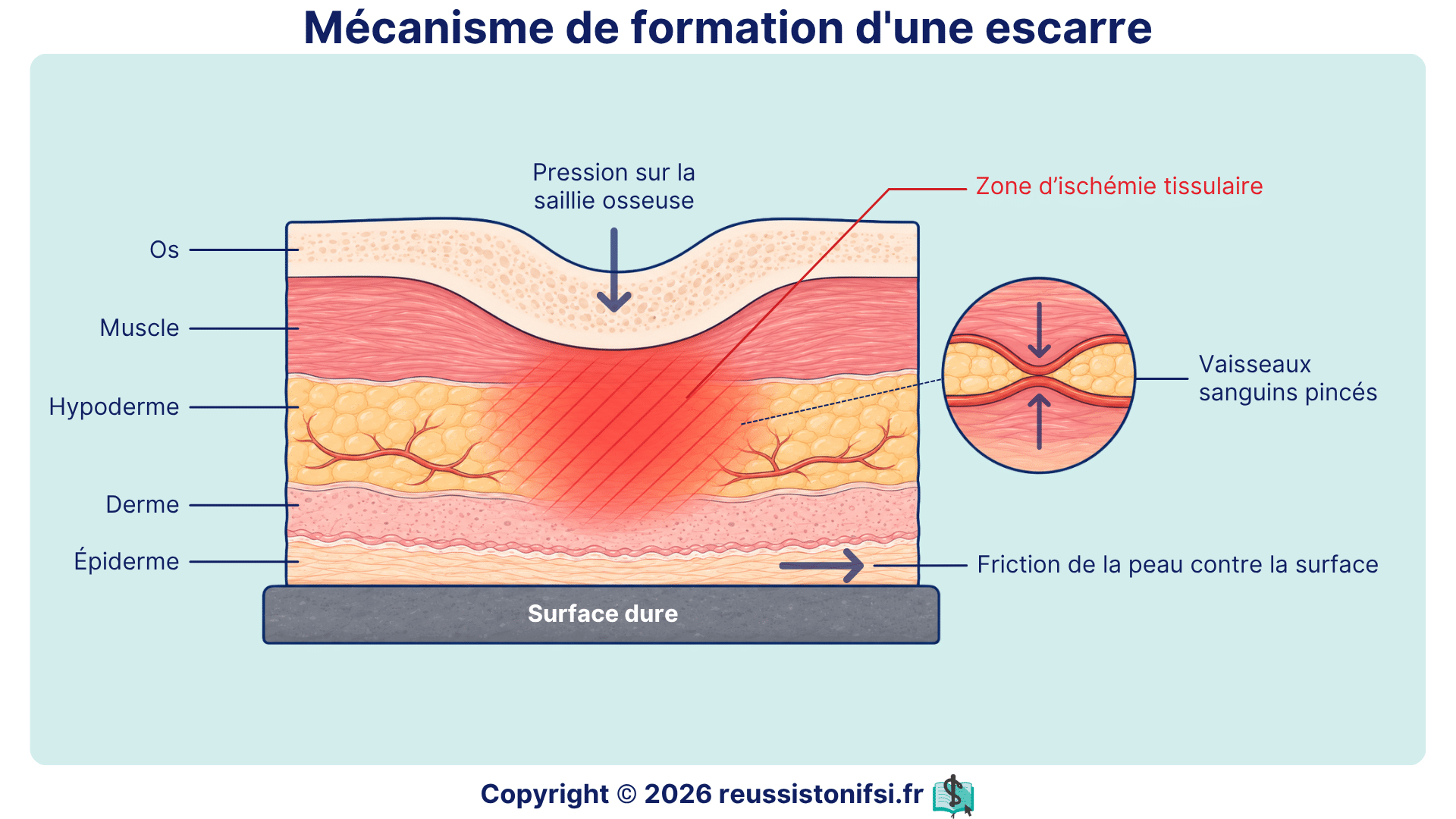 Mécanisme de formation d’une escarre avec pression osseuse, ischémie tissulaire et friction cutanée.