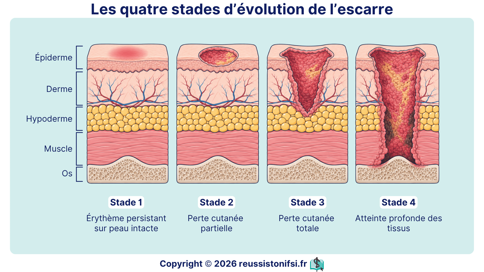 Stades d’évolution de l’escarre montrant l’atteinte progressive de l’épiderme aux tissus profonds.