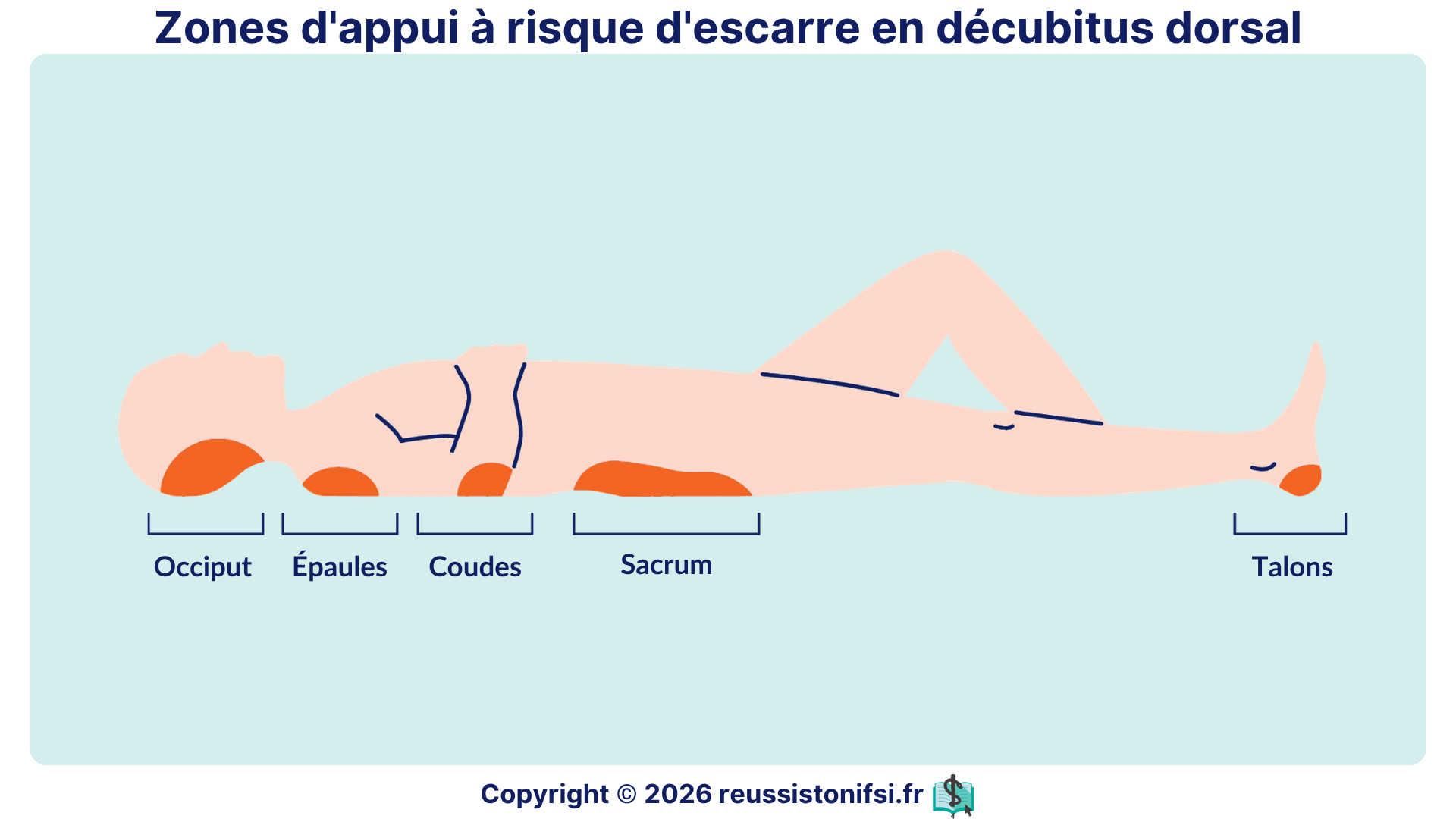Zones d’appui à risque d’escarre en décubitus dorsal : occiput, épaules, coudes, sacrum et talons.