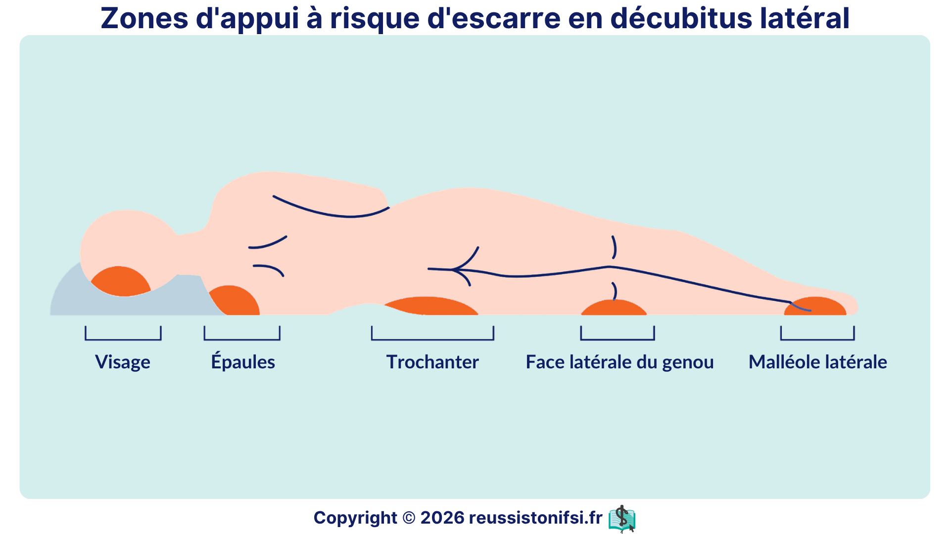 Zones d’appui à risque d’escarre en décubitus latéral : visage, épaules, trochanter, genou et malléole.