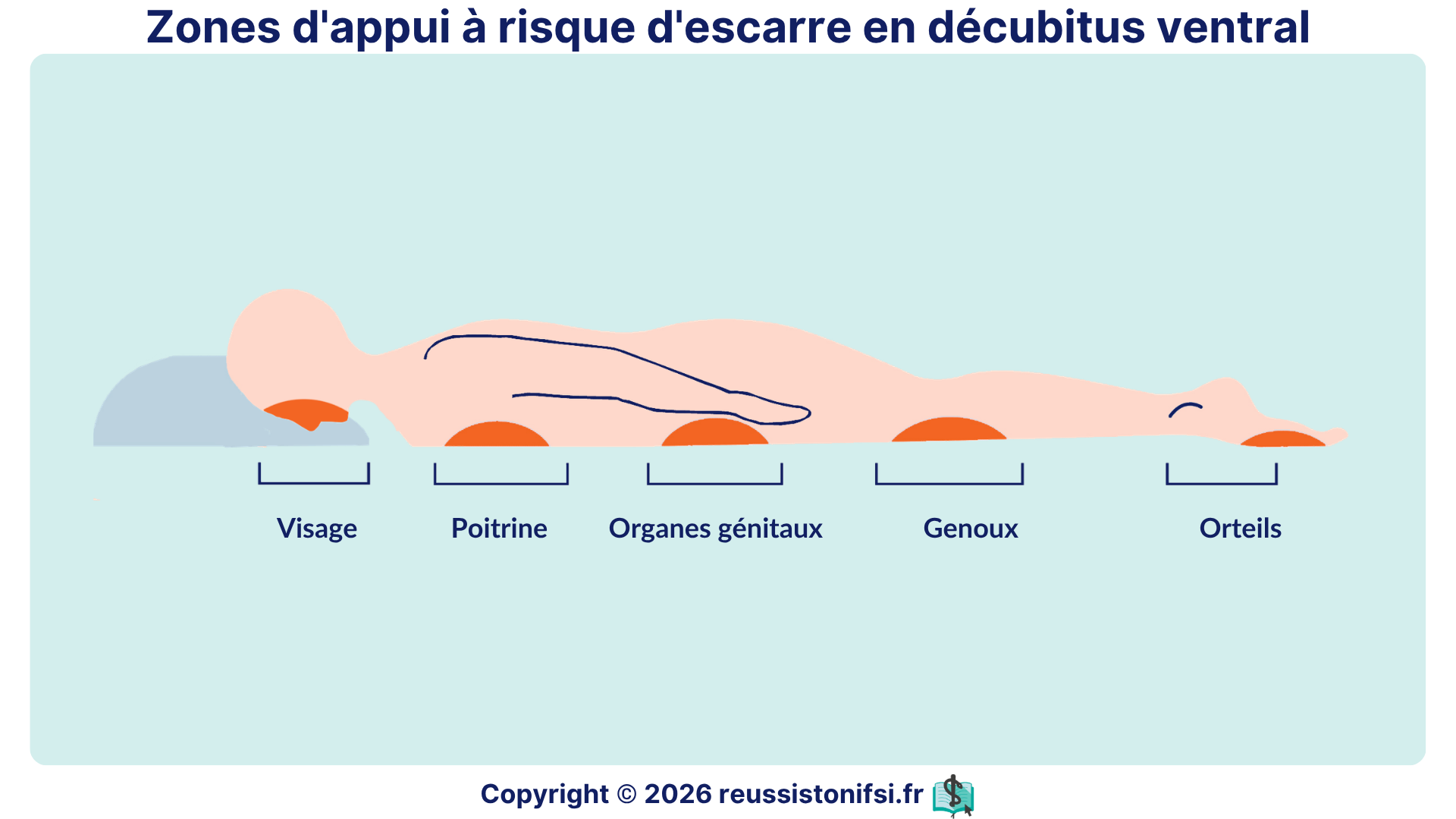 Zones d’appui à risque d’escarre en décubitus ventral : visage, poitrine, organes génitaux, genoux et orteils.