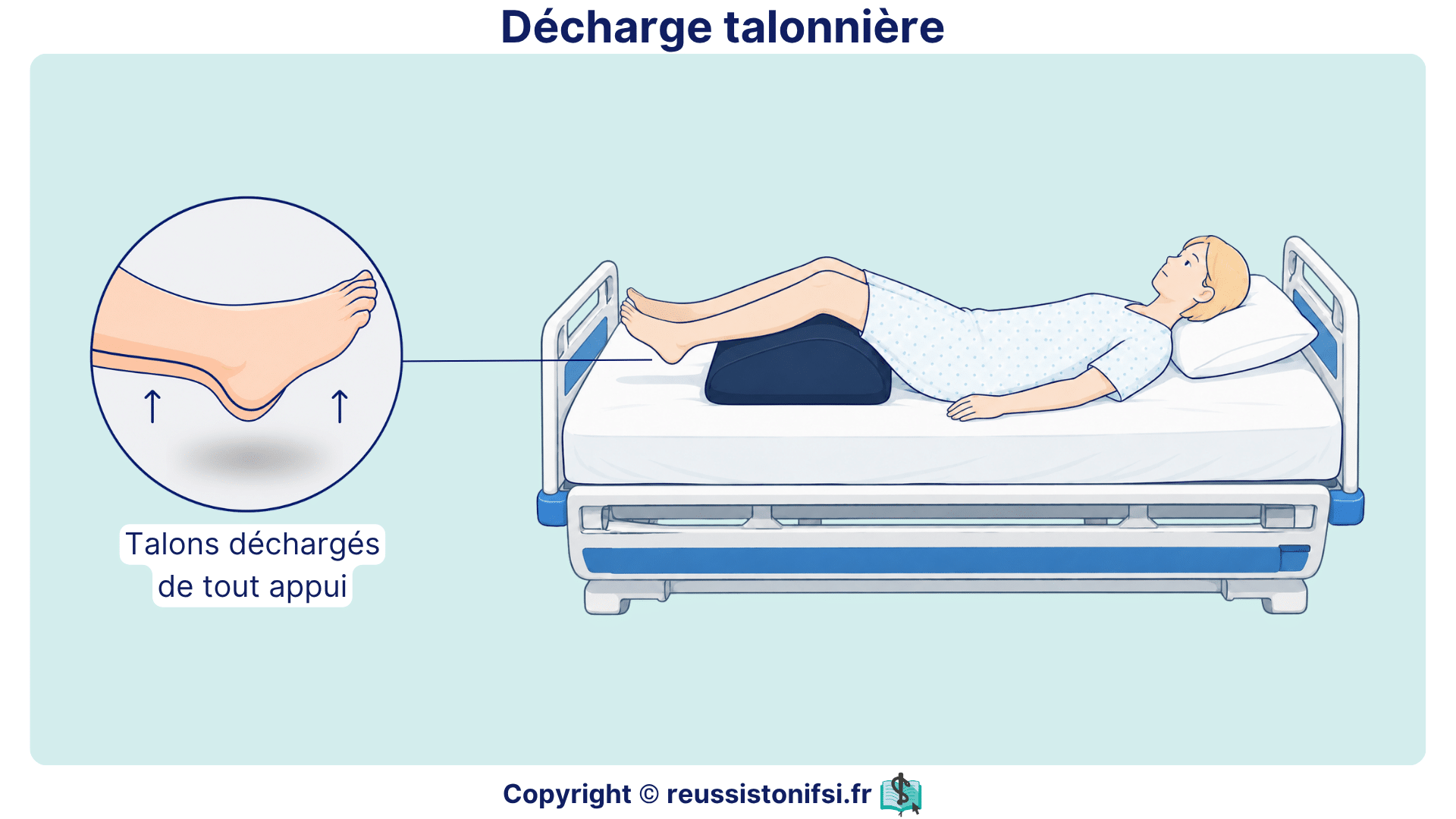 Décharge talonnière : patient alité avec talons suspendus pour prévenir les points d’appui.