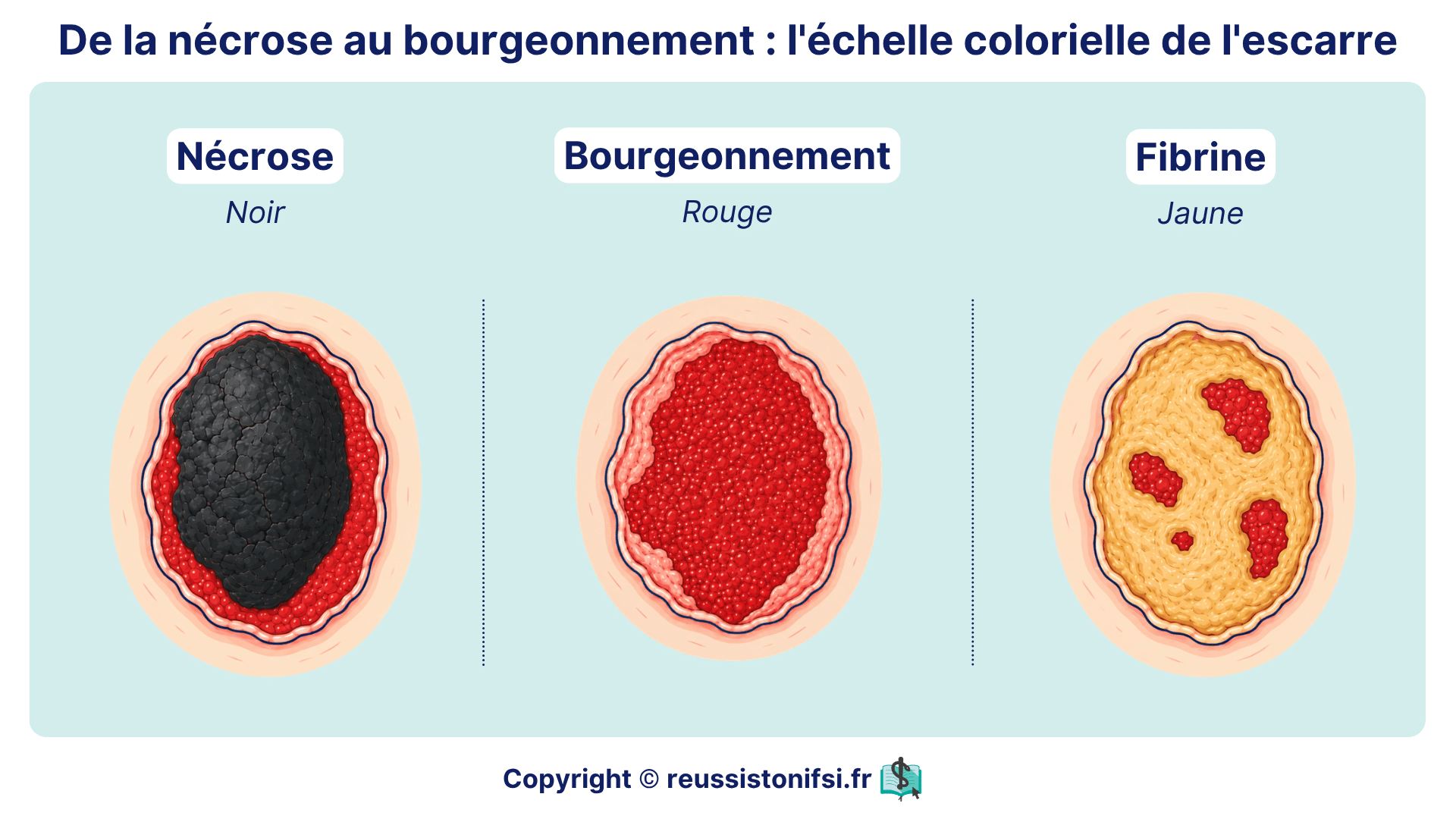 Échelle colorielle de l’escarre montrant la nécrose noire, la fibrine jaune et le bourgeonnement rouge.