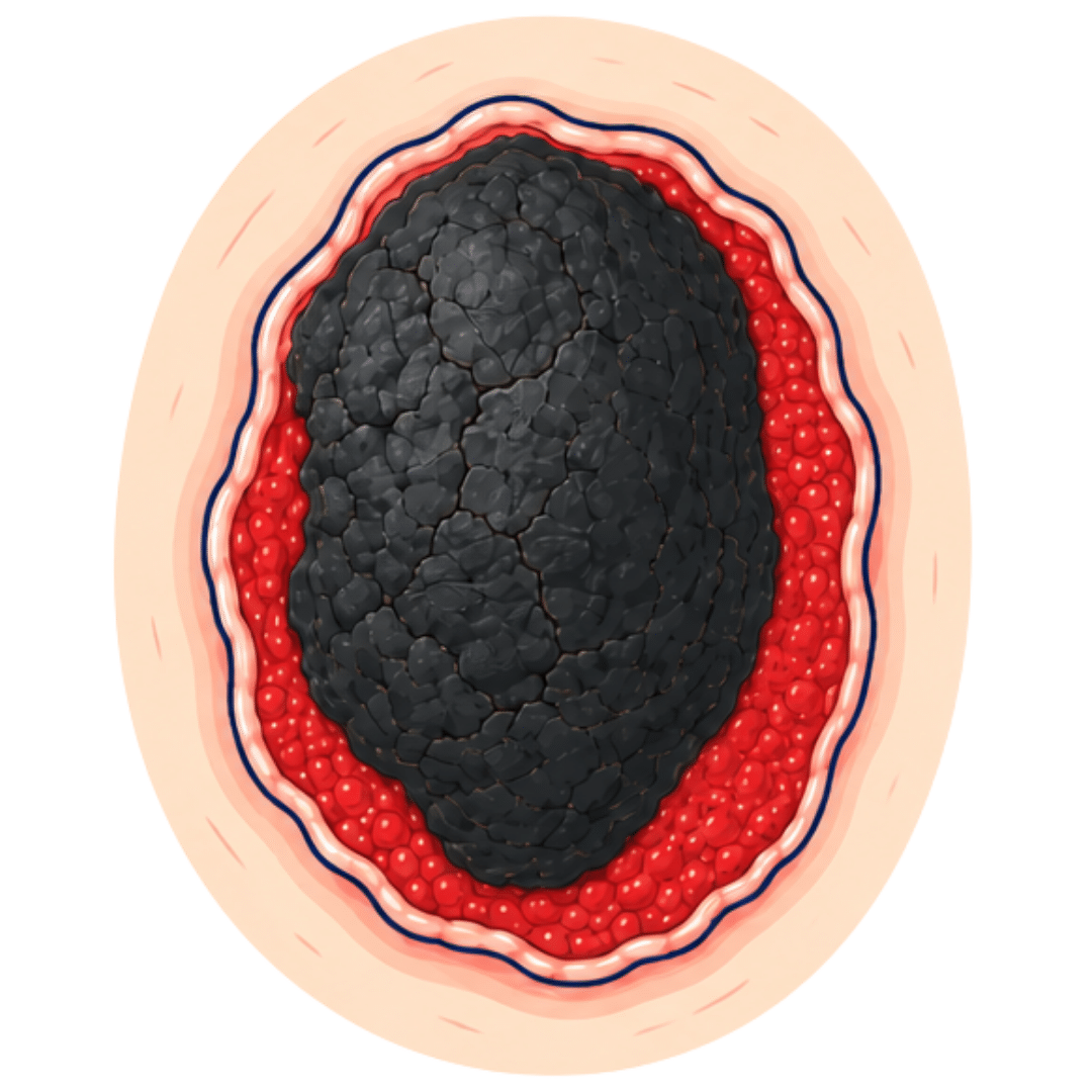 Escarre nécrotique avec plaque noire sèche entourée de tissu de granulation rouge sur le lit de la plaie.