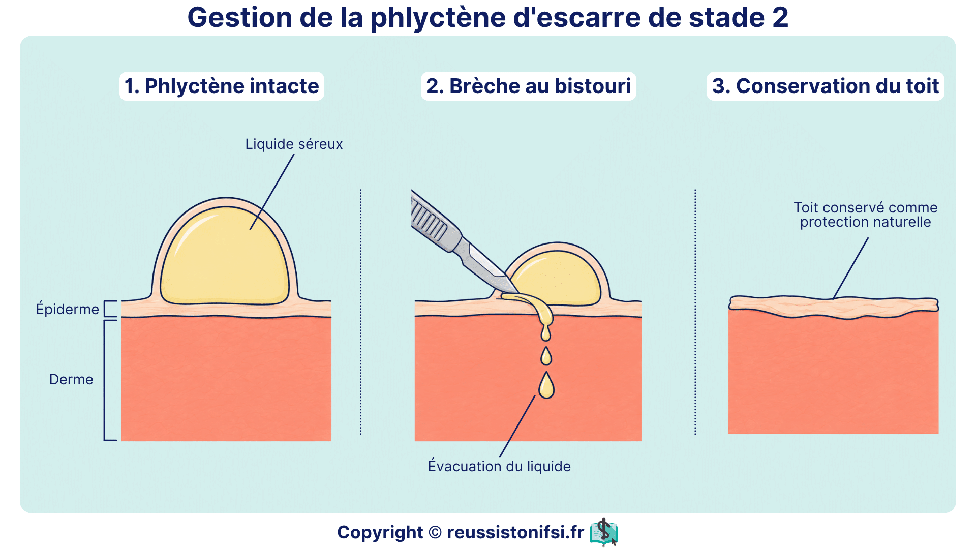 Gestion de la phlyctène d’escarre de stade 2 : ouverture au bistouri, évacuation du liquide et conservation du toit.