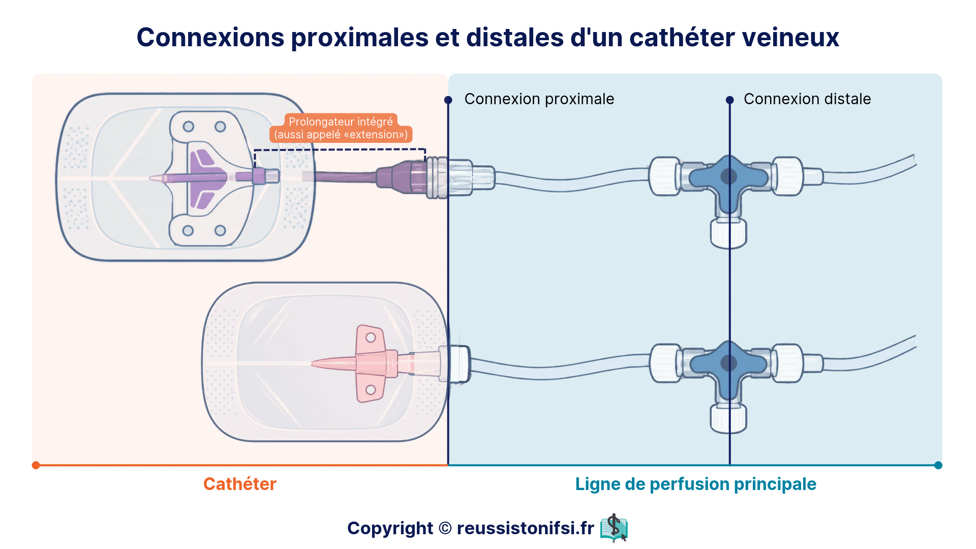 Connexions proximales et distales d’un cathéter veineux, avec ou sans prolongateur intégré, sur une ligne de perfusion.
