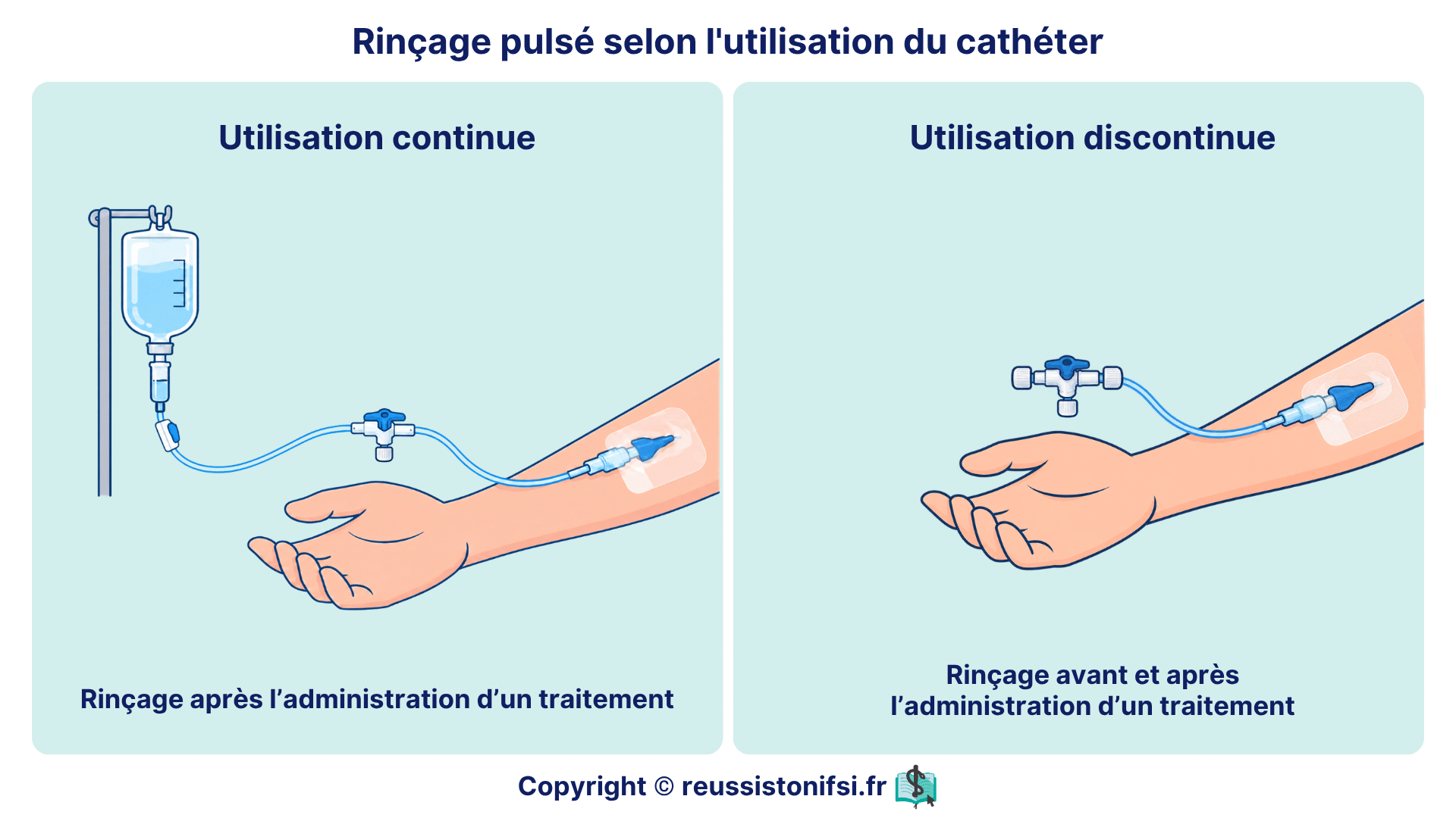 Rinçage pulsé : comparaison des moments de rinçage selon l’utilisation continue ou discontinue du cathéter.